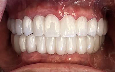 gums_3on6